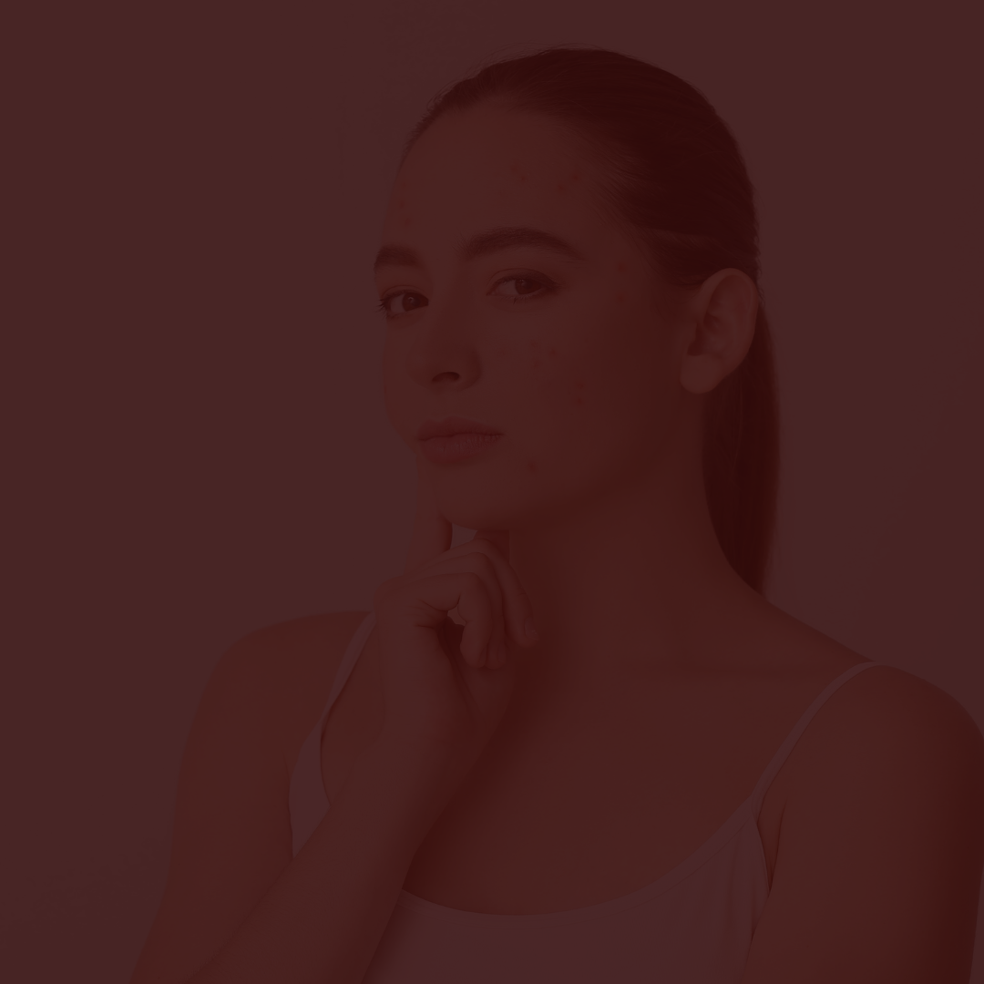 Red light therapy for acne: gentle help for unclean skin